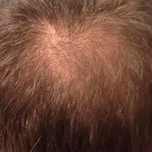 hair loss 2 before