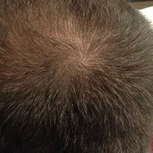 hair loss 3 after