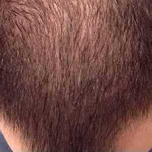 hair loss 4 before