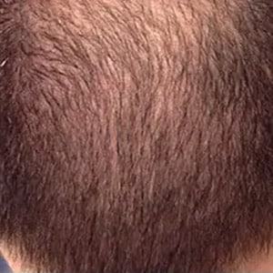 hair loss 5 before