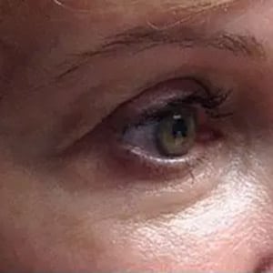microneedling dot wrinkles eyes 1 after