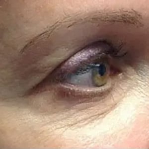 microneedling dot wrinkles eyes 1 before