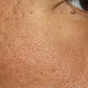 microneedling fraxel acne scars 1 after