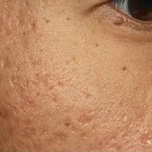 microneedling fraxel acne scars 1 before