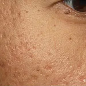 microneedling fraxel acne scars 1 before
