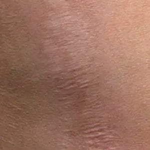 microneedling fraxel scars 1 after
