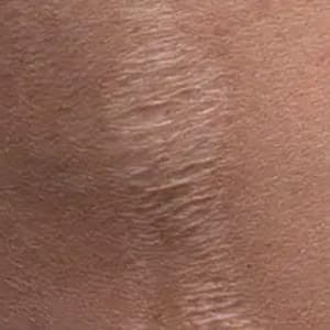 microneedling fraxel scars 1 before