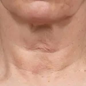 microneedling fraxel wrinkles 1 before