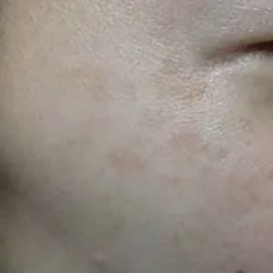 photorejuvenation varilite brownspots 1 after