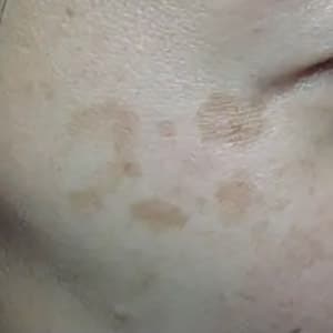 photorejuvenation varilite brownspots 1 before