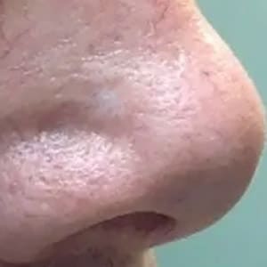 photorejuvenation varilite veins 1 after