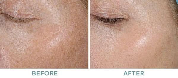 skin 1