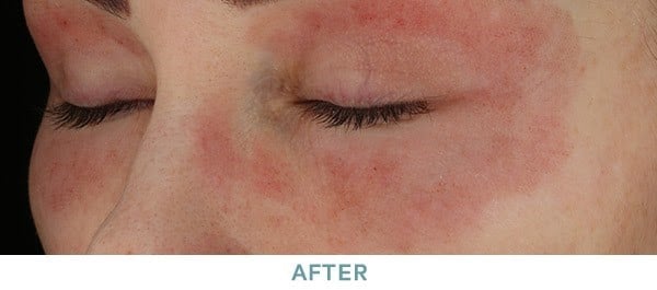 skin 11