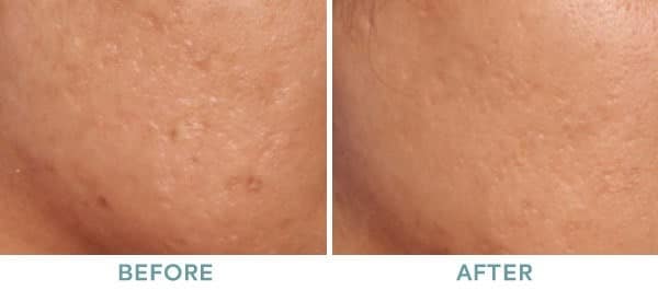 skin 3