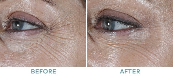 wrinkle 2