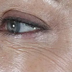 wrinkle relaxers botox eyes 2 after
