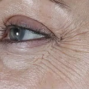 wrinkle relaxers botox eyes 2 before