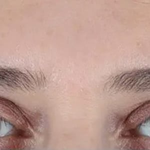 wrinkle relaxers botox glabella 1 after