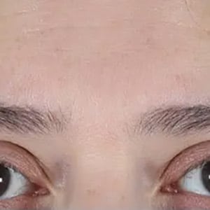 wrinkle relaxers botox glabella 1 before