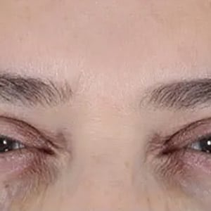 wrinkle relaxers botox glabella 2 after