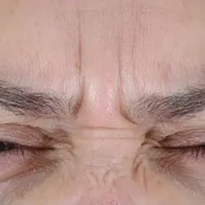 wrinkle relaxers botox glabella 2 before