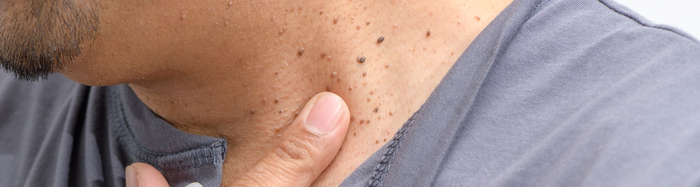 Common Skin Growths - VitalSkin Dermatology