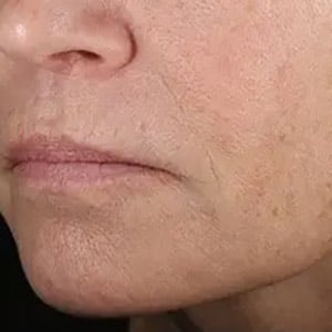injectable juvederm after