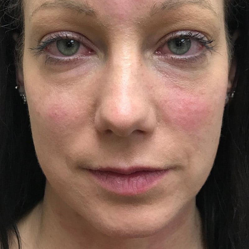 sculptra restylane lyft 1 after