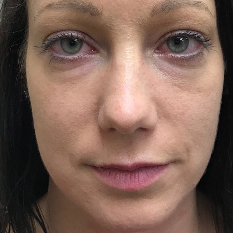 sculptra restylane lyft 1 before