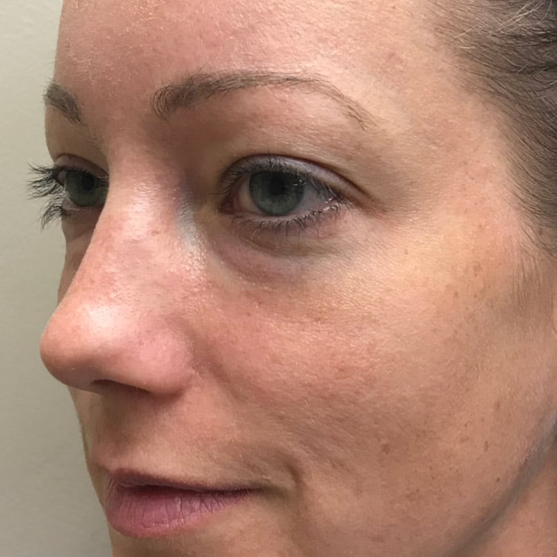 sculptra tear troughs 1 after