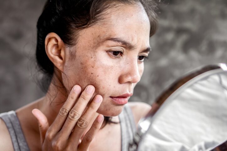 woman having skin problem checking her face with dark spot