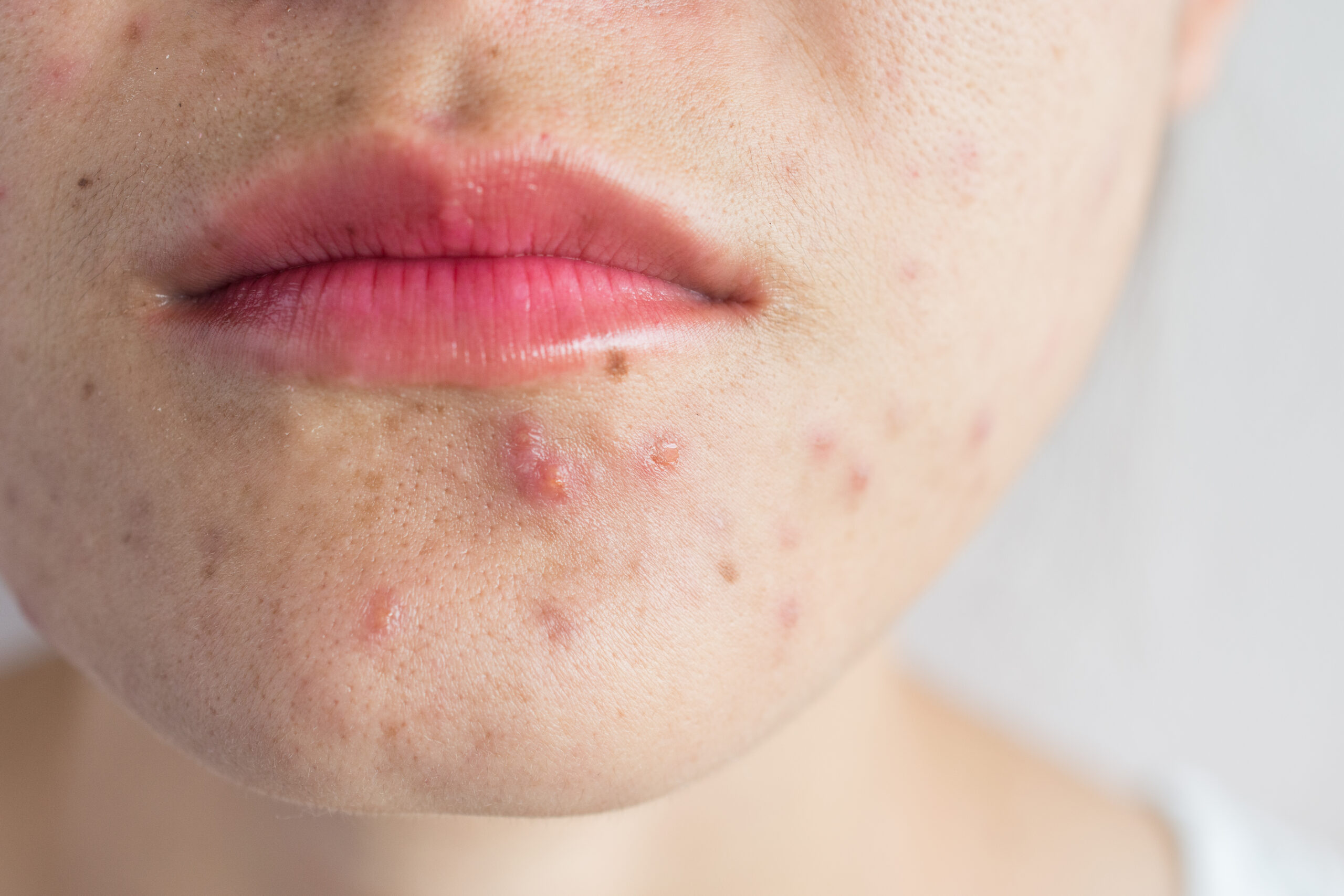 Up close of a face from the nose down with acne