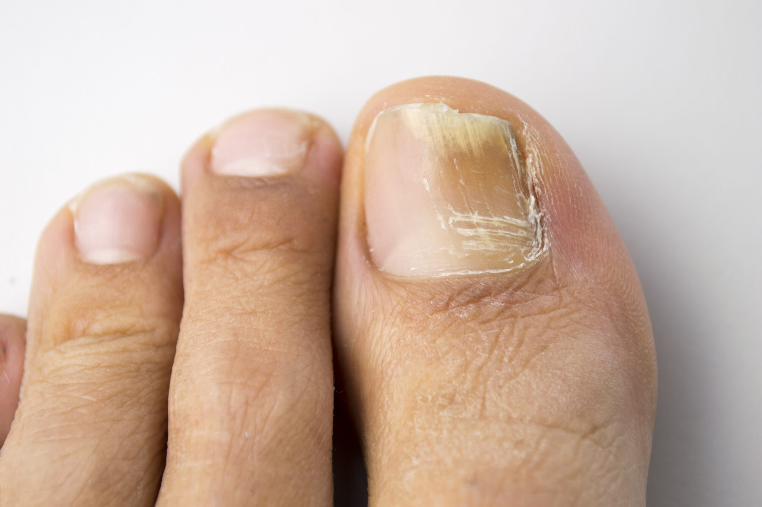 How to Treat Toenail Fungus