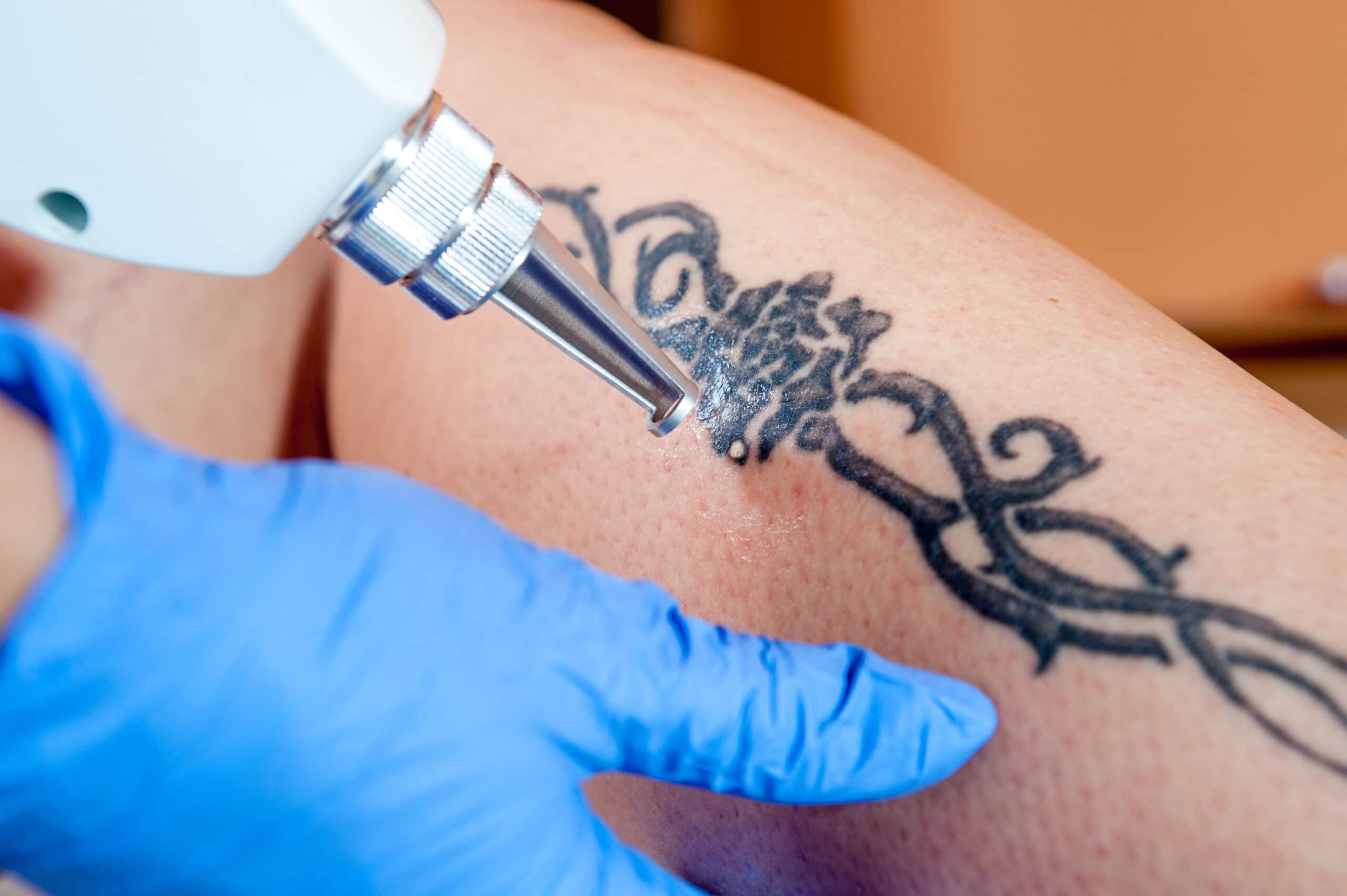 up close of a tattoo being removed using a laser