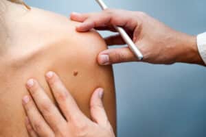 dermatologist examing mole during skin cancer screening