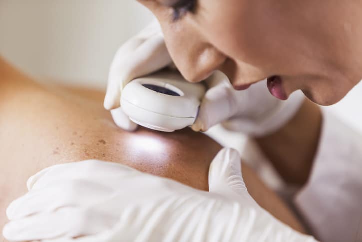 dermatologist examining skin looking for signs of skin cancer