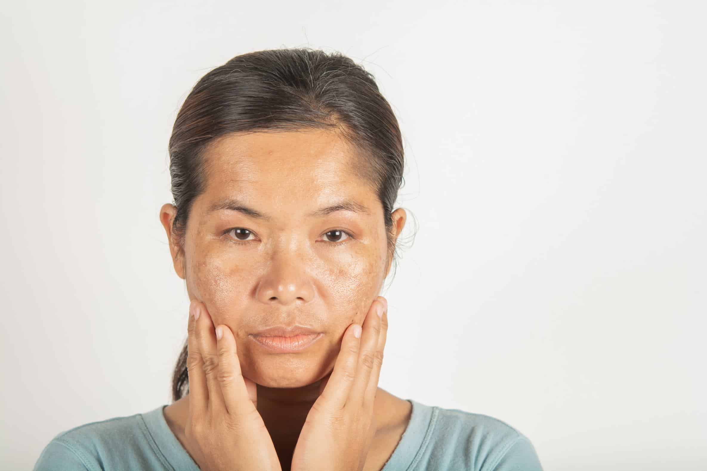 Melasma