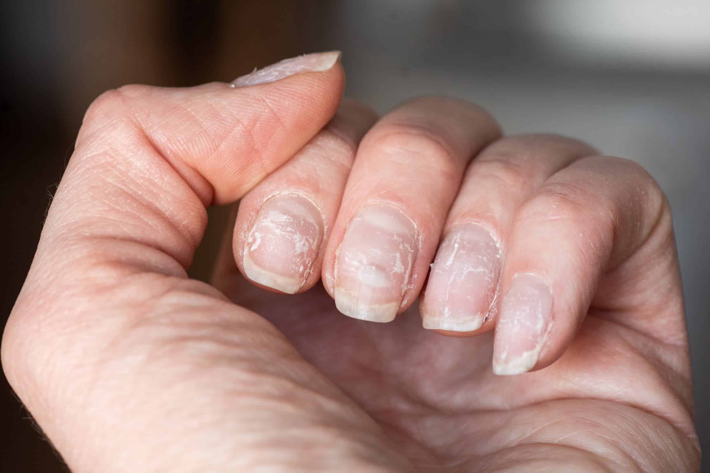 What Does An Absence of Fingernail Moons Mean About Your Health? - Organic  Olivia » Organic Olivia