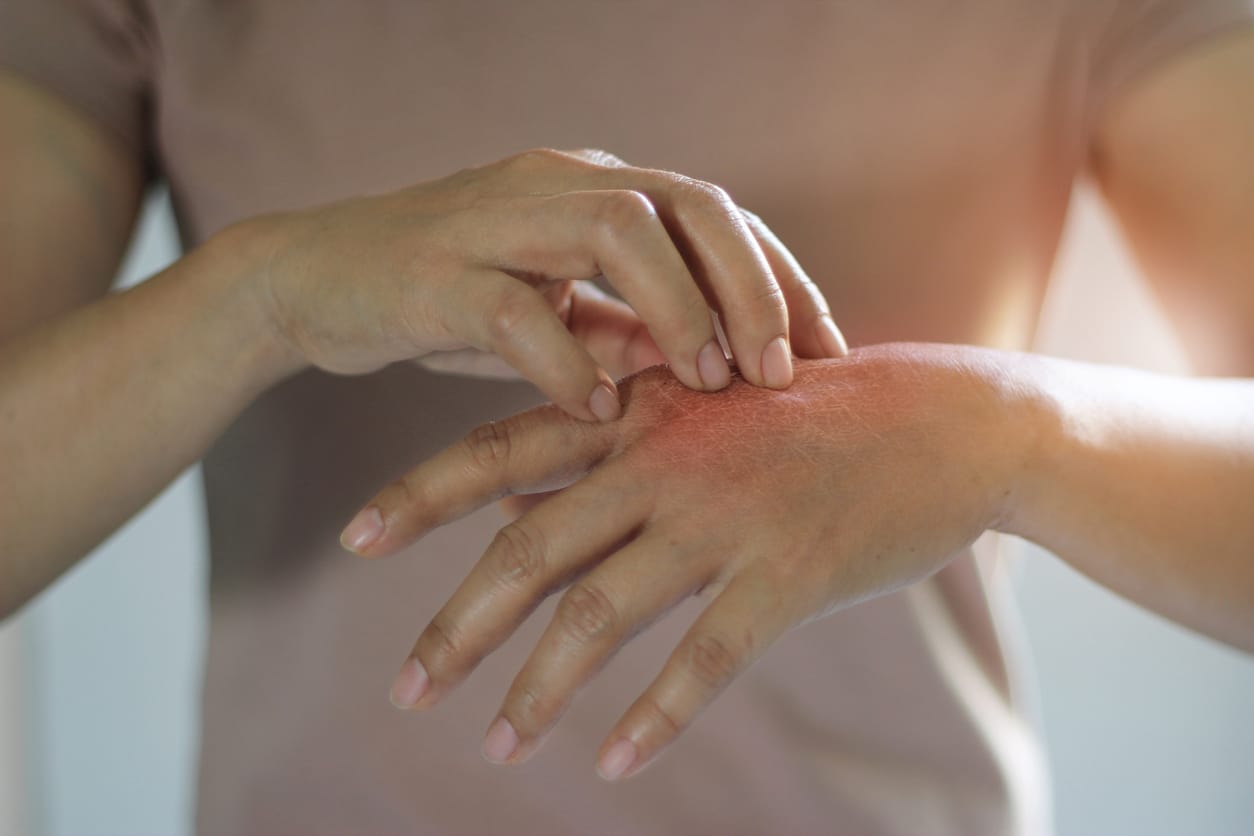 Healthcare and medical concept. Female scratching the itch on her hand, cause of itching from skin diseases, dry skin, allergy, chemical, allergic to detergent or dishwashing liquid and dermatitis, insect bites, burned, drug. Health problem.