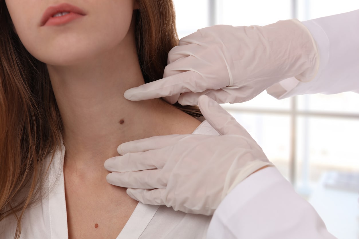 Doctor dermatologist examines mole of patient close up. Checking benign moles.