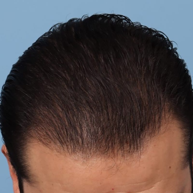 non surgical hair restoration after 2