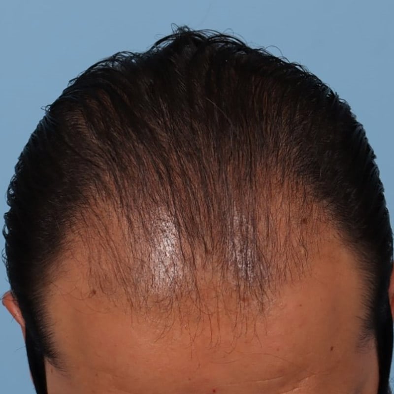 non surgical hair restoration before 2