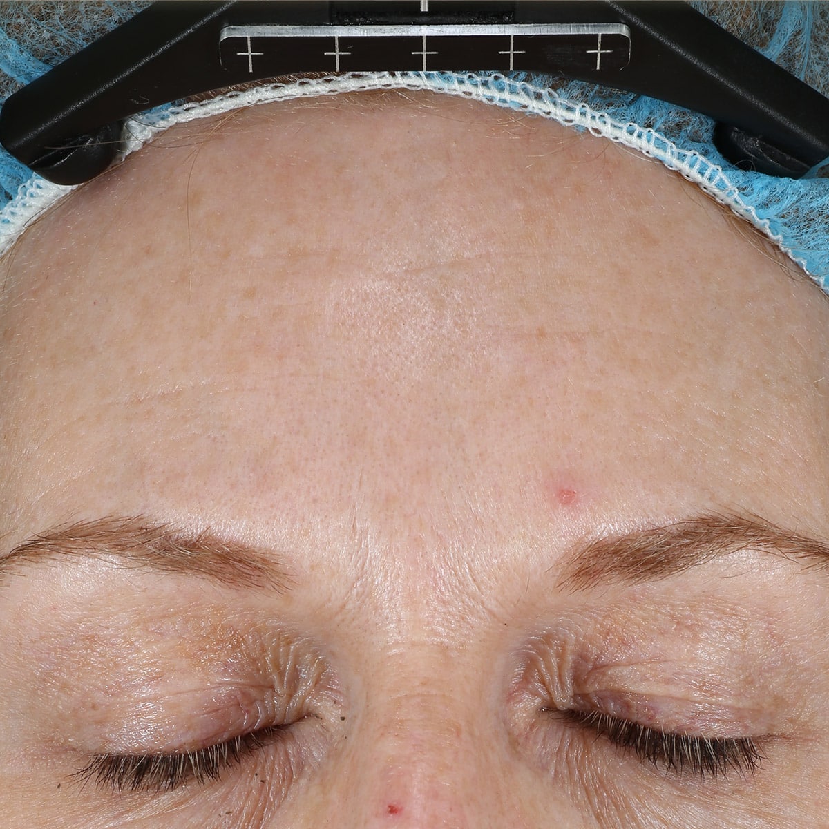 skinpen prp dermapeels after 1