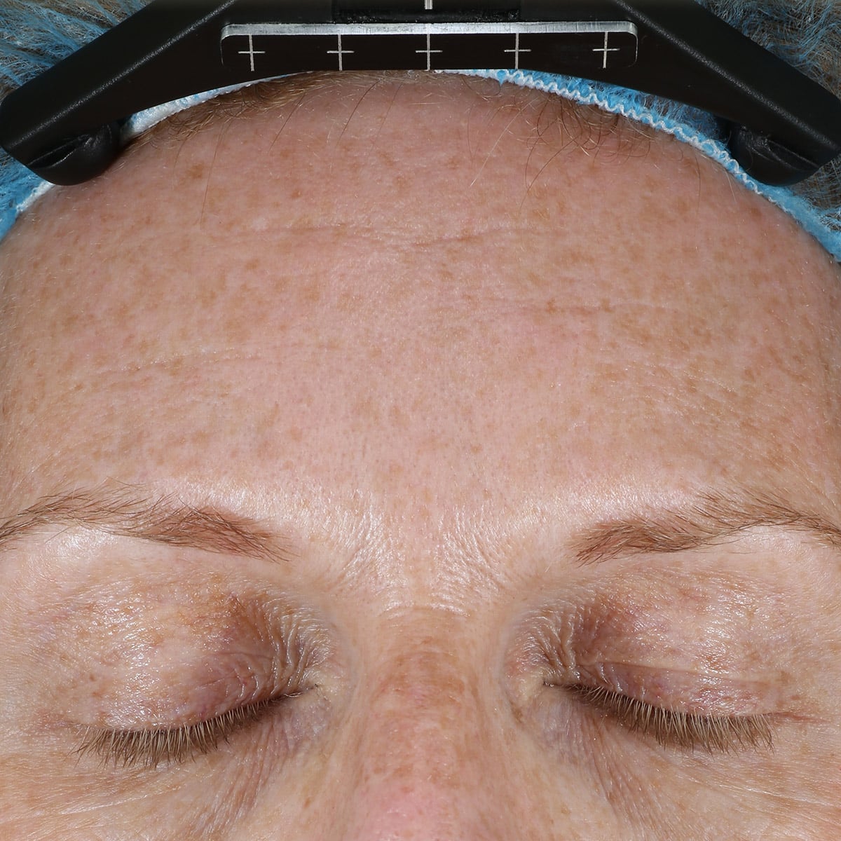 skinpen prp dermapeels before 1