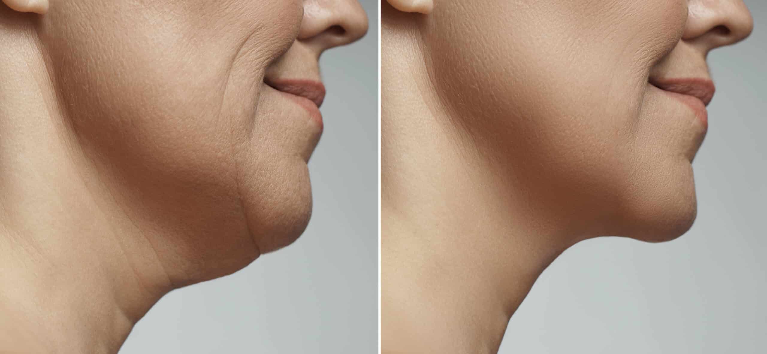 Double chin removal, facelift and neck liposuction