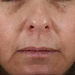 Bucktown BRIGHTENING PEEL LEVEL 2 AND 6 WEEKS POST BRIGHTENING PEEL LEVEL 2 2