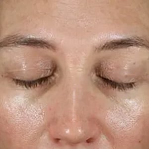 Bucktown BRIGHTENING PEEL LEVEL 2 AND 6 WEEKS POST BRIGHTENING PEEL LEVEL 2