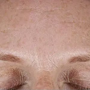 Bucktown Before MICROPEN PRP DERMAPEEL 2