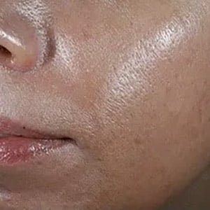 Bucktown DOT FOR TEXTURE ACNE SCARRING AND ENLARGED PORES 2 YEARS AFTER 1 TREATMENT