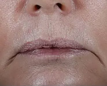 Bucktown DOT FOR WRINKLES AROUND THE MOUTH 6 MONTHS AFTER 1ST TREATMENT 2